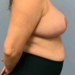 Breast Reduction Before & After Patient #11877