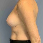 Breast Reconstruction Before & After Patient #11884