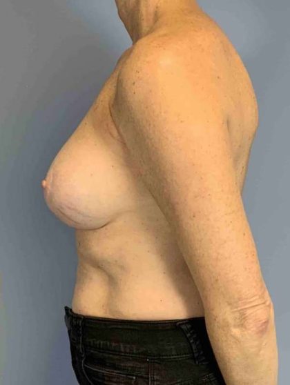 Breast Reconstruction Before & After Patient #11884