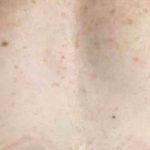 Breast Reconstruction Before & After Patient #11887