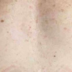 Breast Reconstruction Before & After Patient #11887