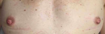 Breast Reconstruction Before & After Patient #11887