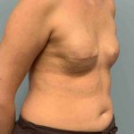Breast Reconstruction Before & After Patient #11894