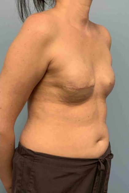 Breast Reconstruction Before & After Patient #11894