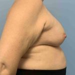 Breast Reconstruction Before & After Patient #11901