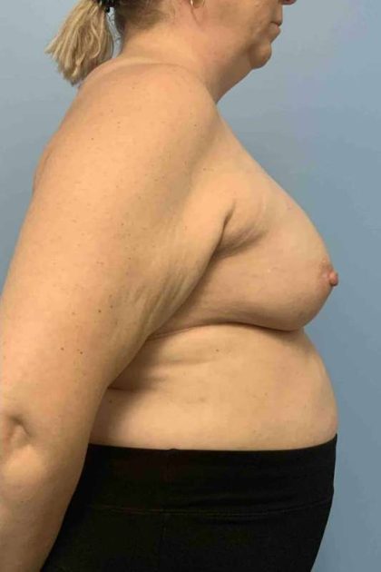 Breast Reconstruction Before & After Patient #11901