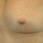 Breast Reconstruction Before & After Patient #11908