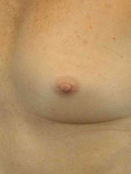 Breast Reconstruction Before & After Patient #11908