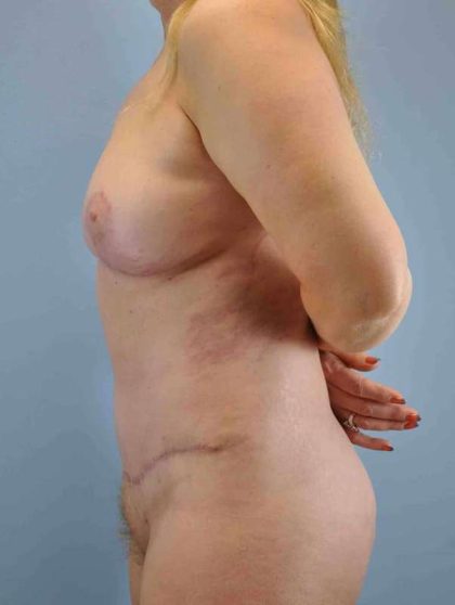 Breast Lift Before & After Patient #11931