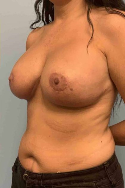 Breast Lift Before & After Patient #11980