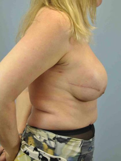 Breast Lift Before & After Patient #12021