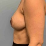 Breast Lift Before & After Patient #12042