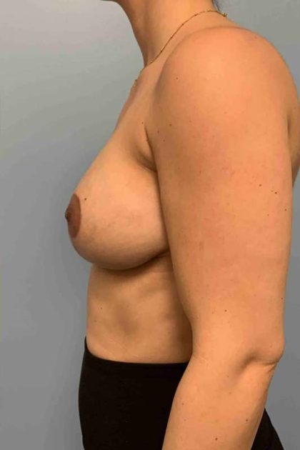 Breast Lift Before & After Patient #12042