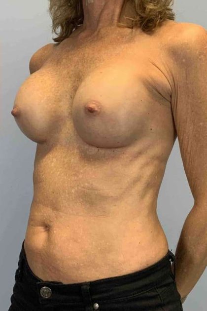 Breast Augmentation Before & After Patient #12049