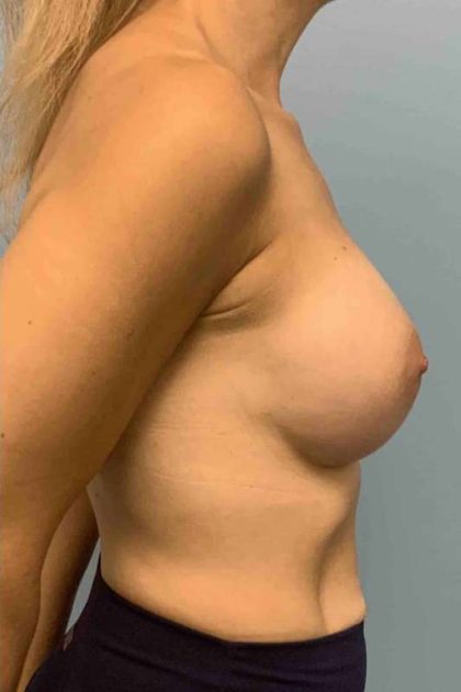 Breast Augmentation Before & After Patient #12056
