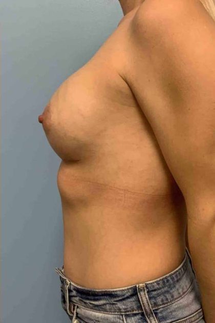 Breast Augmentation Before & After Patient #12063
