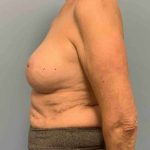 Breast Augmentation Before & After Patient #12082
