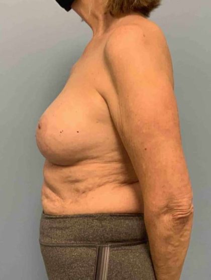 Breast Augmentation Before & After Patient #12082