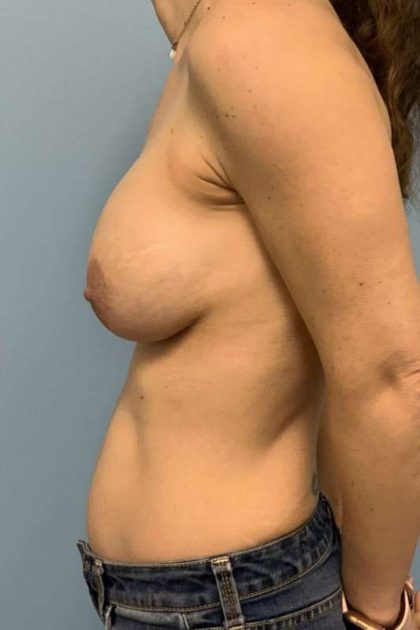 Breast Augmentation Before & After Patient #12108
