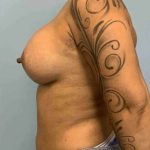 Breast Augmentation Before & After Patient #12113