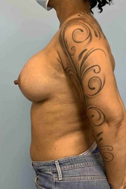 Breast Augmentation Before & After Patient #12113