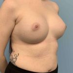 Breast Augmentation Before & After Patient #12157