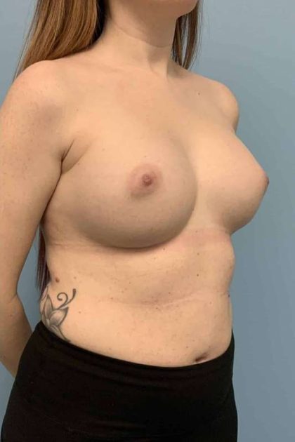 Breast Augmentation Before & After Patient #12157