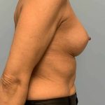 Breast Augmentation Before & After Patient #12171