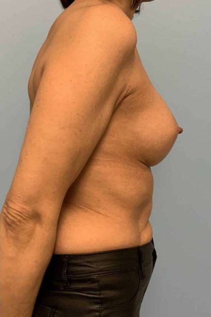 Breast Augmentation Before & After Patient #12171
