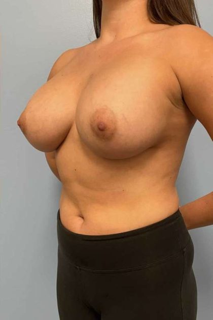 Breast Augmentation Before & After Patient #12178