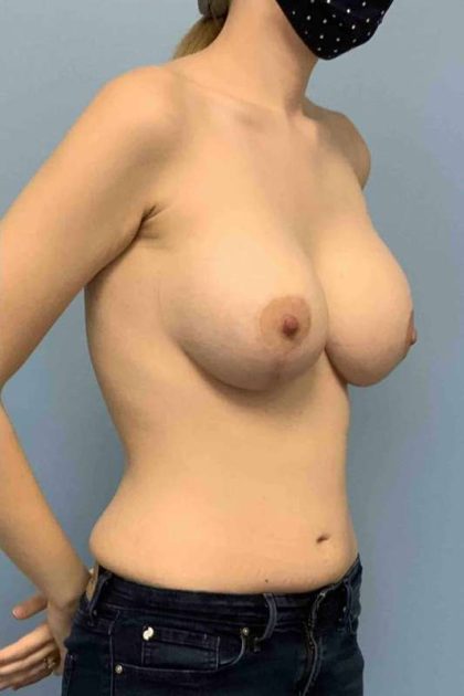 Breast Augmentation Before & After Patient #12185