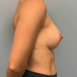 Breast Augmentation Before & After Patient #12206