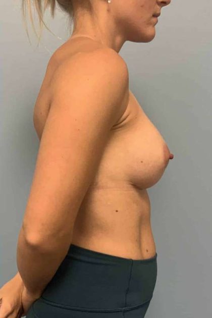Breast Augmentation Before & After Patient #12206