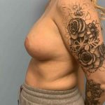 Breast Augmentation Before & After Patient #12227