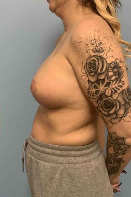 Breast Augmentation Before & After Patient #12227