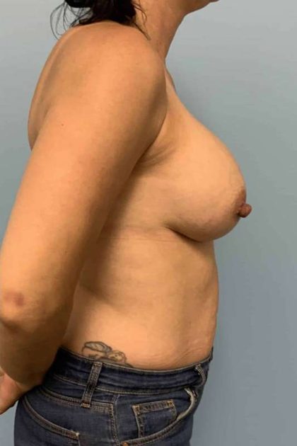 Breast Augmentation Before & After Patient #12246