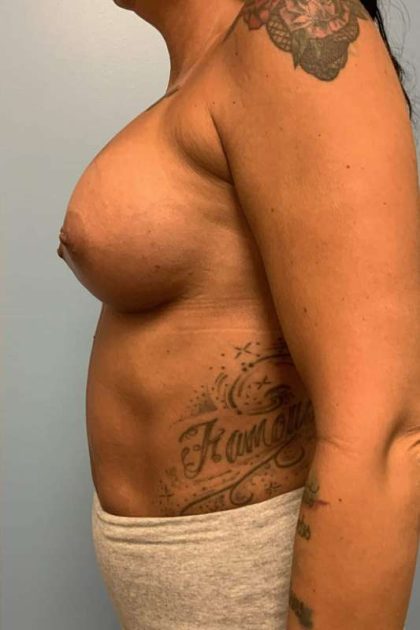 Breast Augmentation Before & After Patient #12253