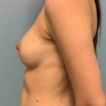 Breast Augmentation Before & After Patient #12267