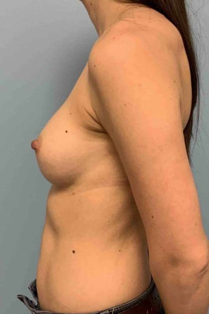 Breast Augmentation Before & After Patient #12267