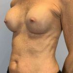 Breast Augmentation Before & After Patient #12281