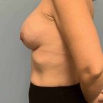 Breast Augmentation Before & After Patient #12295