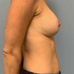 Breast Augmentation Before & After Patient #12302