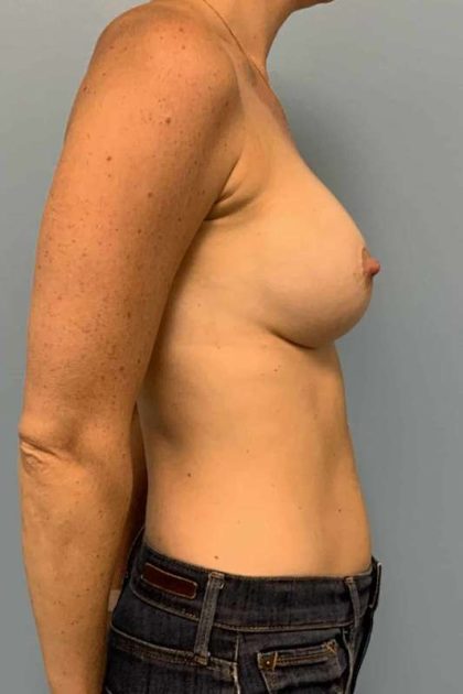 Breast Augmentation Before & After Patient #12302