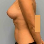 Breast Augmentation Before & After Patient #12330