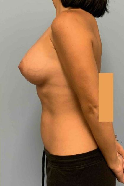 Breast Augmentation Before & After Patient #12330
