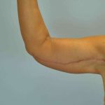 Brachioplasty Before & After Patient #12335