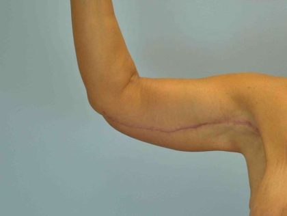 Brachioplasty Before & After Patient #12335