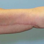 Brachioplasty Before & After Patient #12353