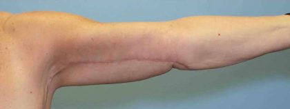 Brachioplasty Before & After Patient #12353