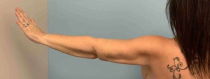 Brachioplasty Before & After Patient #12362